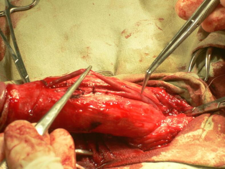 Penis-Lipofilling zur Penisvergrößerung