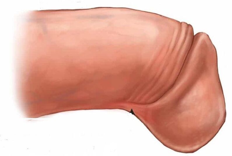 wie man die Eichel des Penis vergrößert